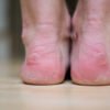 Diabetic Foot Health: Protecting Your Wellbeing Step by Step