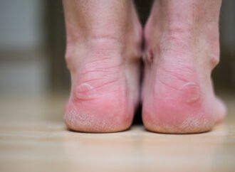 Diabetic Foot Health: Protecting Your Wellbeing Step by Step