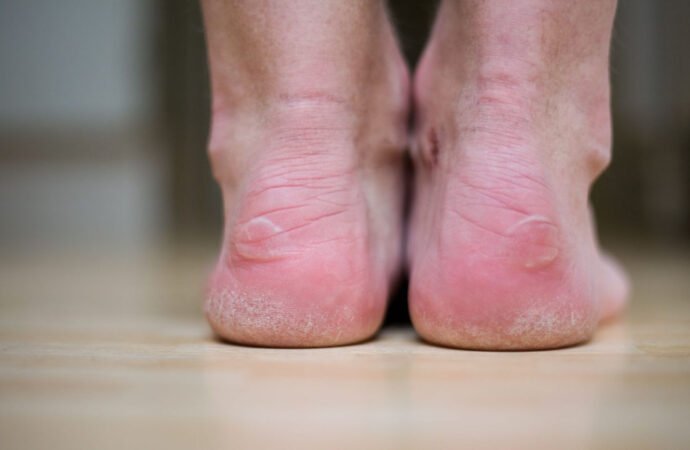 Diabetic Foot Health: Protecting Your Wellbeing Step by Step