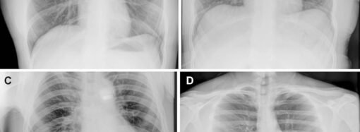 Astronauts take first x-rays in space