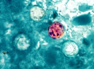 ‘Explosive diarrhea’ outbreak grips US: How researchers search for its origin