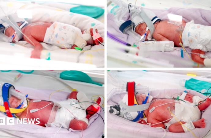 Rare identical quadruplets born in Australia