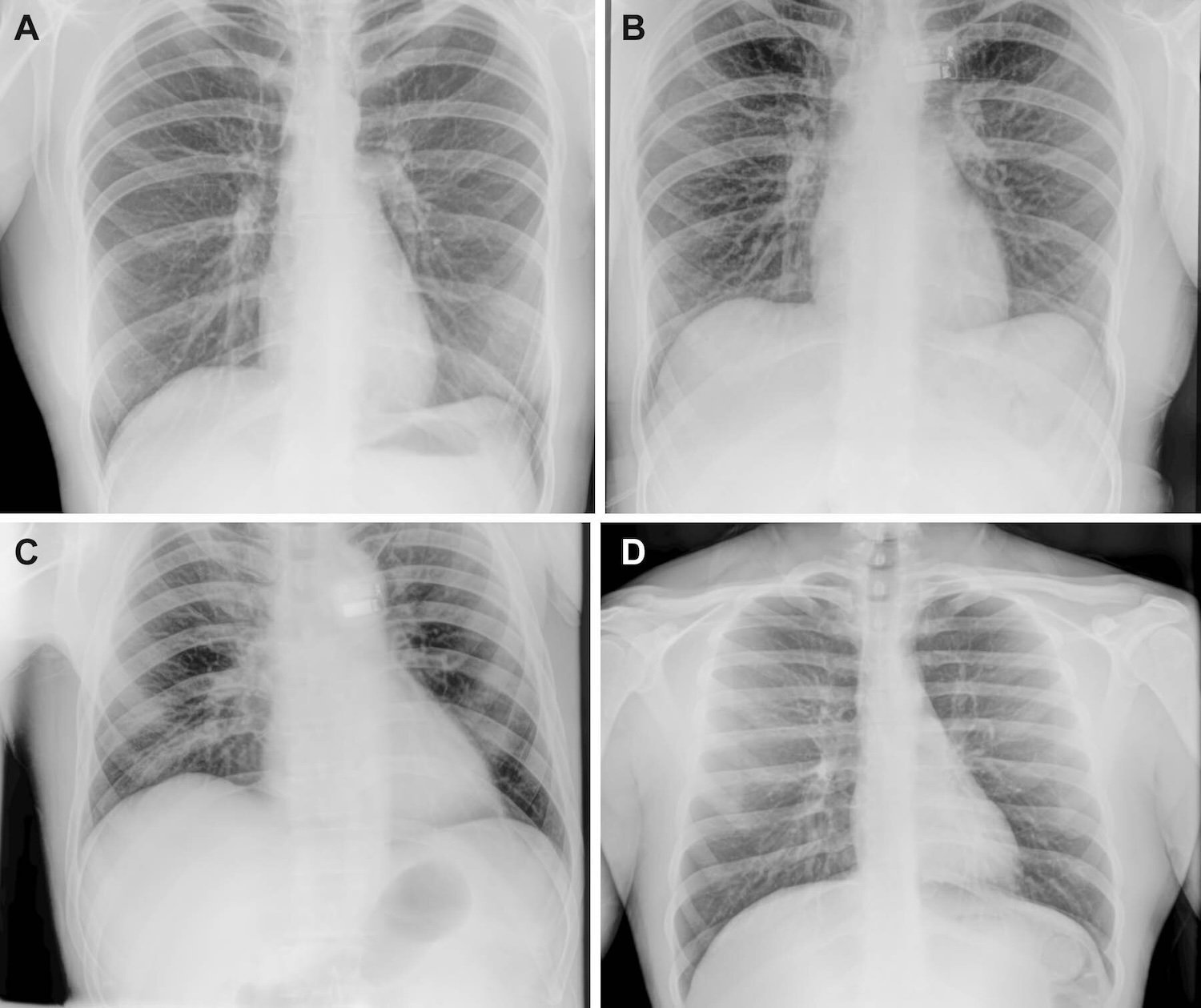 Representative chest x-rays before, during and after the flight. Chest radiographs were acquired (A) before flight by a crew member, (B, C) in flight on day 3 after launch (L+3) by a crew member, and (D) after flight by a non-crew operator using the same imaging protocol. Credit: Radiological Society of North America (RSNA)