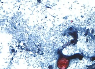 The outbreak of the parasite that causes diarrhea exceeds 1,000 cases