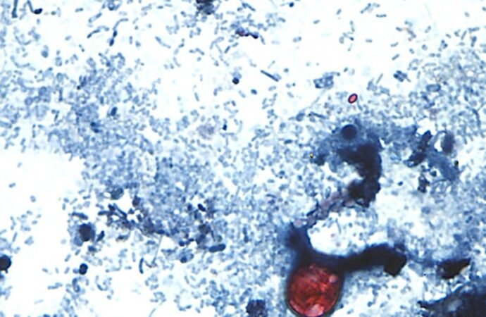 The outbreak of the parasite that causes diarrhea exceeds 1,000 cases