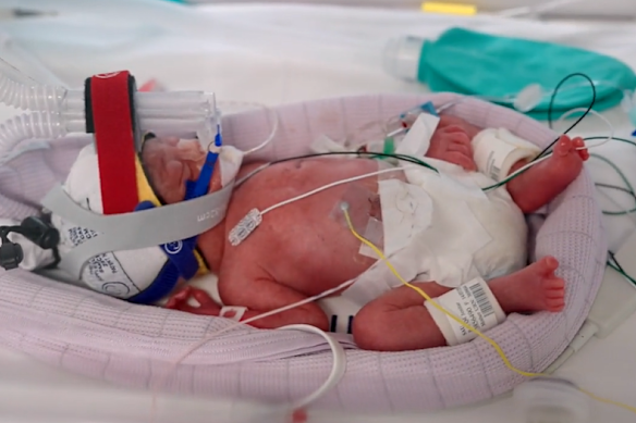 The four girls, Emily, Harriet, Alexa and Catherine, were born by Caesarean section.