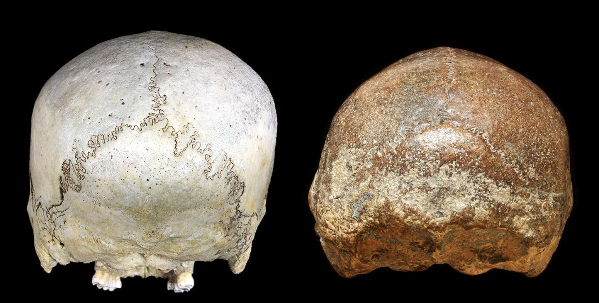 Posterior views of the skulls of a historical human (left) and Homo erectus from Ngawi, Java (right: undated), exhibiting severe transverse deformation plagiocephaly. Image: Kaifu Y et al. 2026 CC POR.