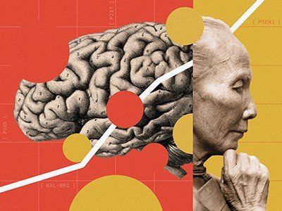 A controversial Alzheimer’s surgery is said to reverse symptoms — here’s what scientists know