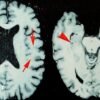 NFL: At least one in four dead players had brain disease, says study