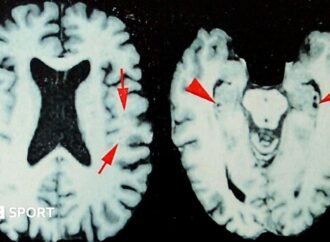 NFL: At least one in four dead players had brain disease, says study