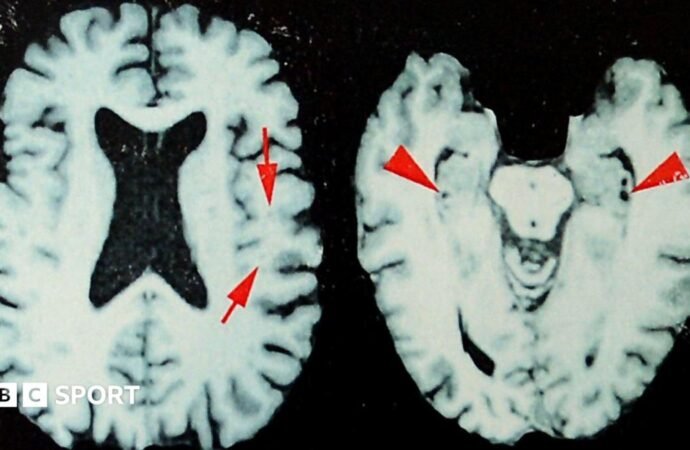 NFL: At least one in four dead players had brain disease, says study