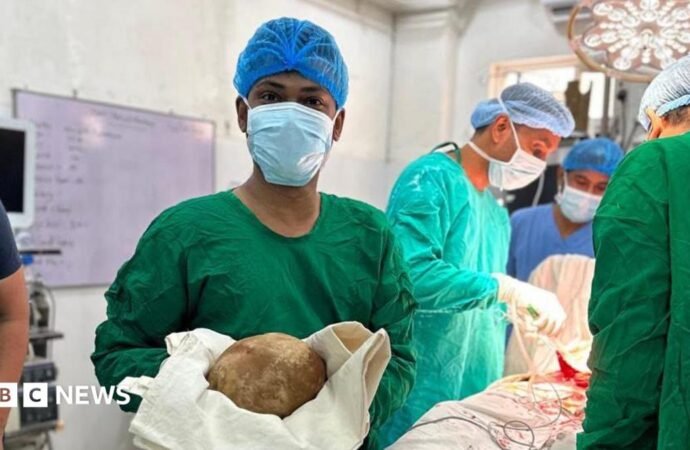Sri Lanka: Doctors remove 3.1kg stone from man’s bladder