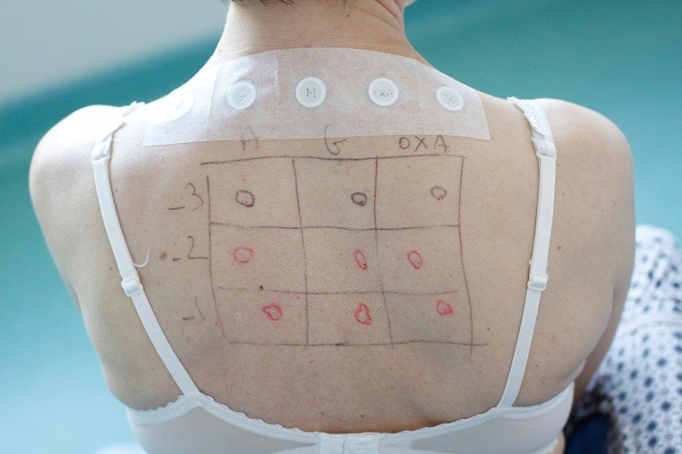 The bare back of a woman showing an allergens test grid.