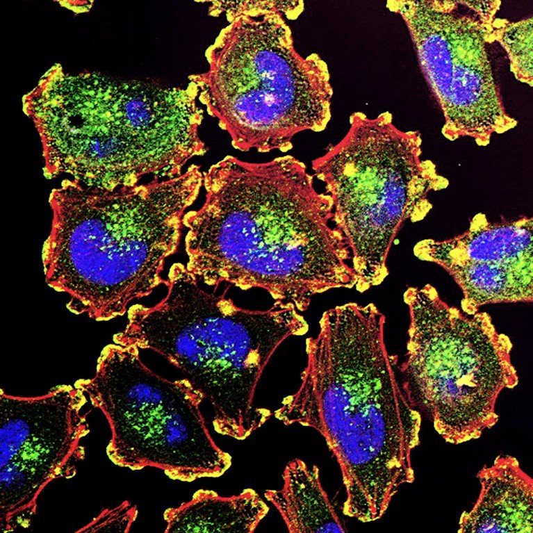 Fluorescence light micrograph of metastatic melanoma cells.