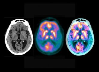 Map of brain ‘microproteins’ could offer new clues to Alzheimer’s disease