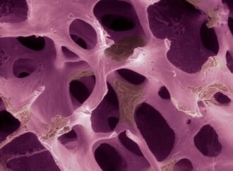 Osteoporosis affects millions: could modified cells rebuild their bones?