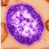 Pennsylvania says an unvaccinated woman has died from measles-related complications