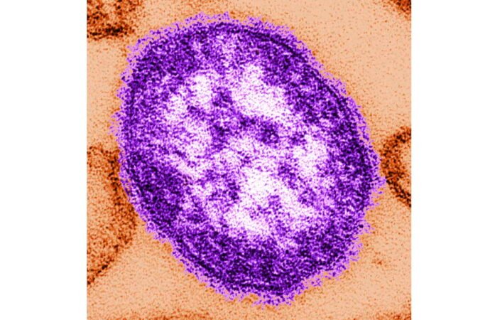 Pennsylvania says an unvaccinated woman has died from measles-related complications