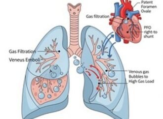 Risks of Decompression Sickness and Venous Thromboembolism during Spaceflight and Patent Foramen Ovale Implications – NASA
