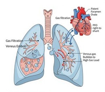 Risks of Decompression Sickness and Venous Thromboembolism during Spaceflight and Patent Foramen Ovale Implications – NASA