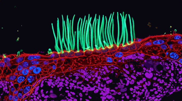 Abnormal beating of cilia, the tiny hair-like structures that line the airways and beat in coordinated waves to move mucus and debris out of the lungs.