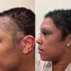 I couldn’t afford a $13,000 hair transplant in the US. So I flew to Turkey and I love the results.