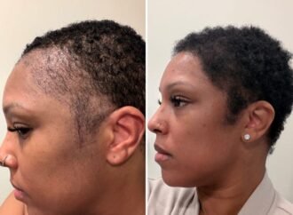 I couldn’t afford a $13,000 hair transplant in the US. So I flew to Turkey and I love the results.