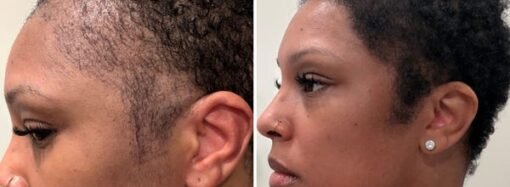I couldn’t afford a $13,000 hair transplant in the US. So I flew to Turkey and I love the results.
