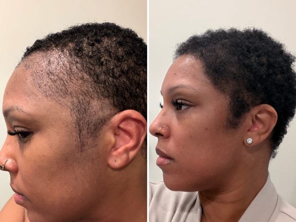 I couldn’t afford a $13,000 hair transplant in the US. So I flew to Turkey and I love the results.