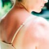 Moderna mRNA vaccine almost halves the risk of skin cancer returning