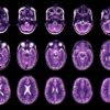 Teen depression and anxiety predicted by childhood brain development