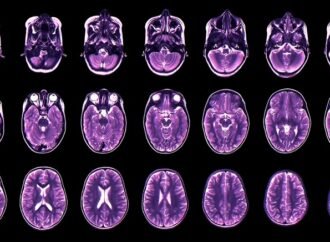 Teen depression and anxiety predicted by childhood brain development