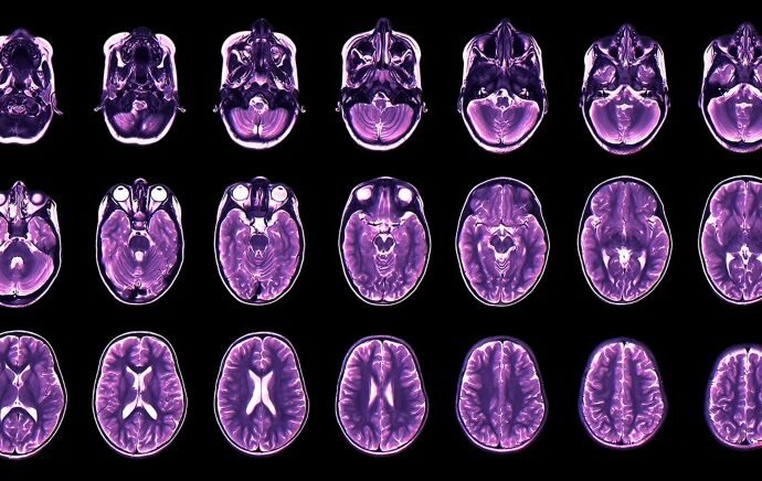 Teen depression and anxiety predicted by childhood brain development