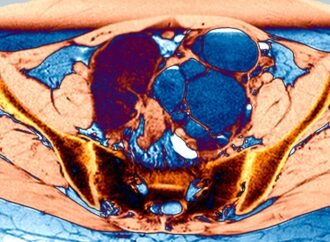 The ‘missed disease’ that affects 190 million: endometriosis drug shows early promise