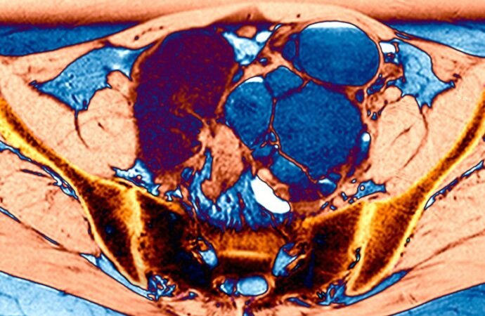The ‘missed disease’ that affects 190 million: endometriosis drug shows early promise