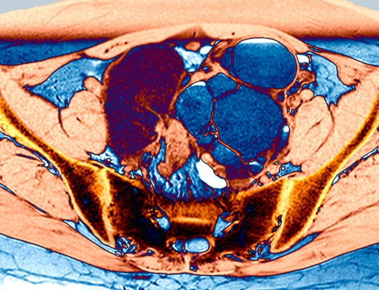 MRI scan showing endometriosis and an ovarian cyst.