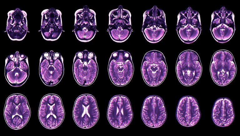 A series of twenty-one coloured magnetic resonance imaging scans in axial section of the healthy brain of a young boy.